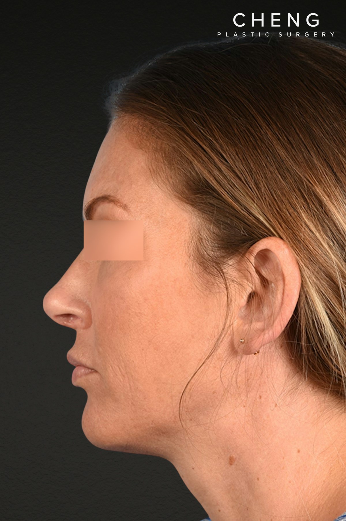 Rhinoplasty Before & After Gallery - Patient 117002 - Image 2