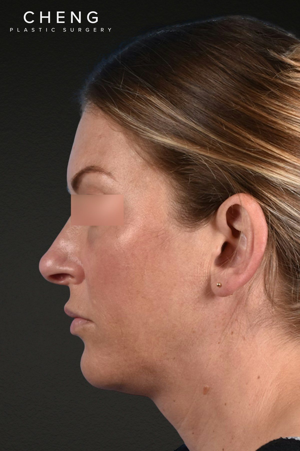Rhinoplasty Before & After Gallery - Patient 117002 - Image 1