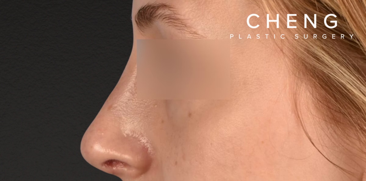 Rhinoplasty Before & After Gallery - Patient 265382 - Image 2