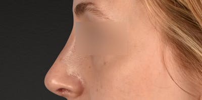 Rhinoplasty Before & After Gallery - Patient 265382 - Image 2