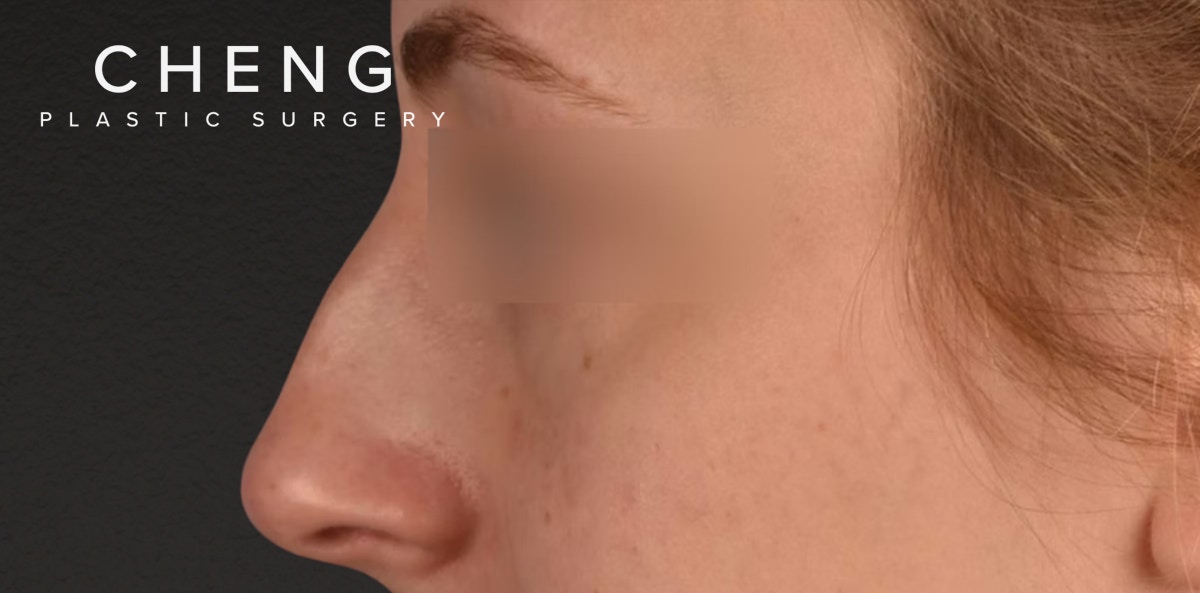 Rhinoplasty Before & After Gallery - Patient 265382 - Image 1