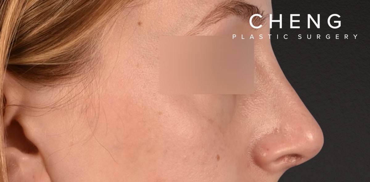 Rhinoplasty Before & After Gallery - Patient 265382 - Image 4
