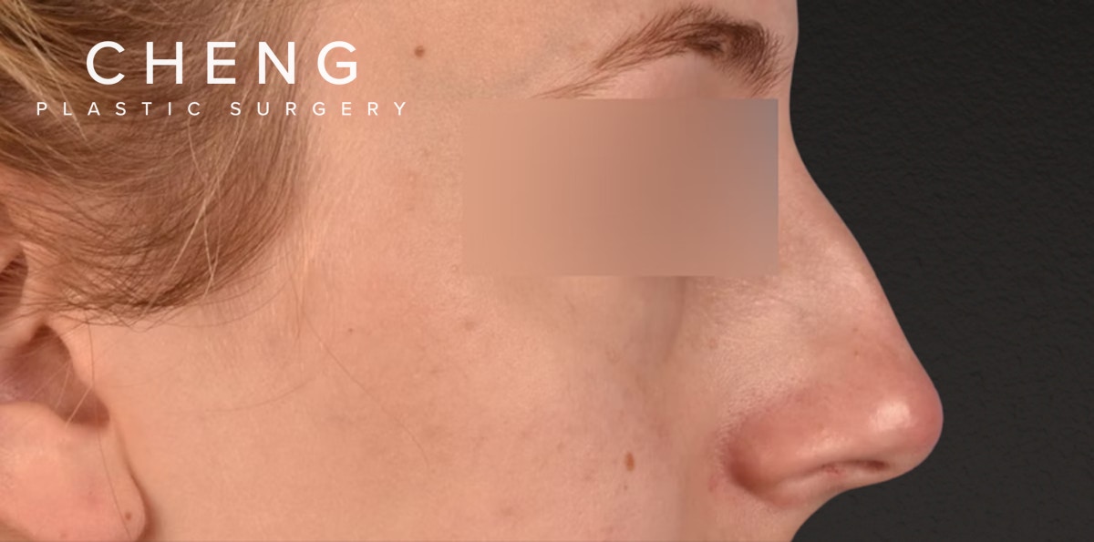 Rhinoplasty Before & After Gallery - Patient 265382 - Image 3