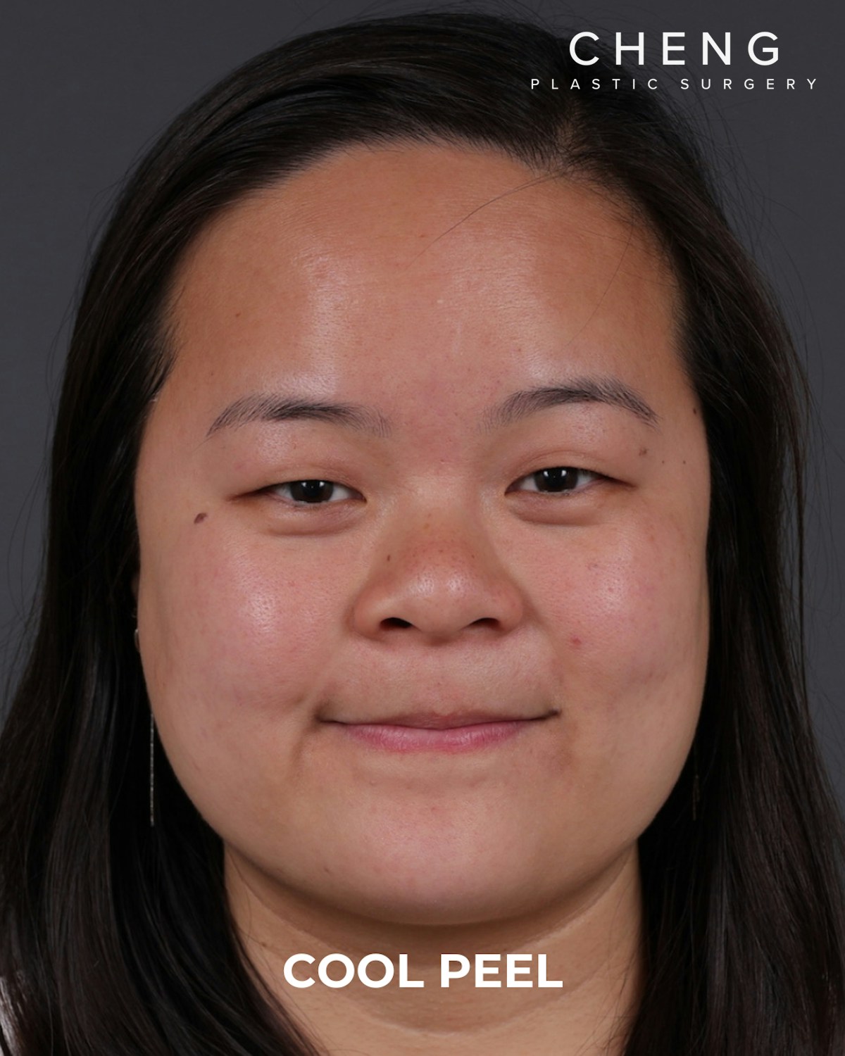 Co2 Laser Before & After Gallery - Patient 416341 - Image 6