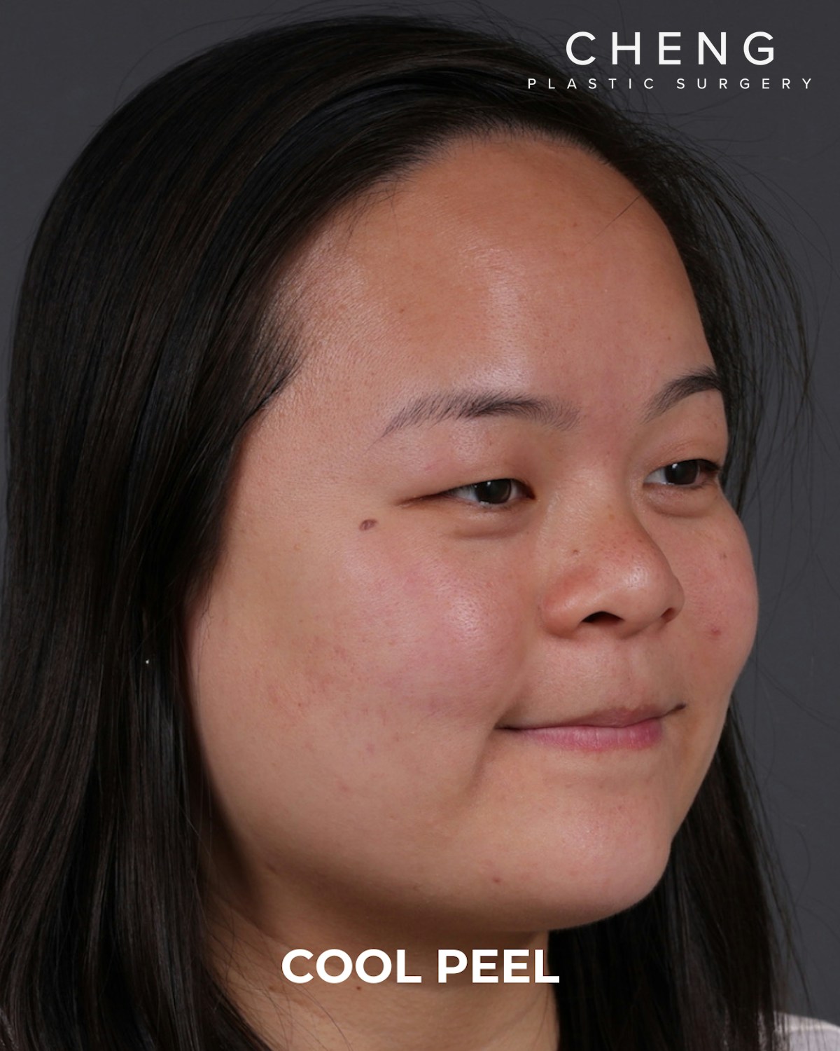Co2 Laser Before & After Gallery - Patient 416341 - Image 2