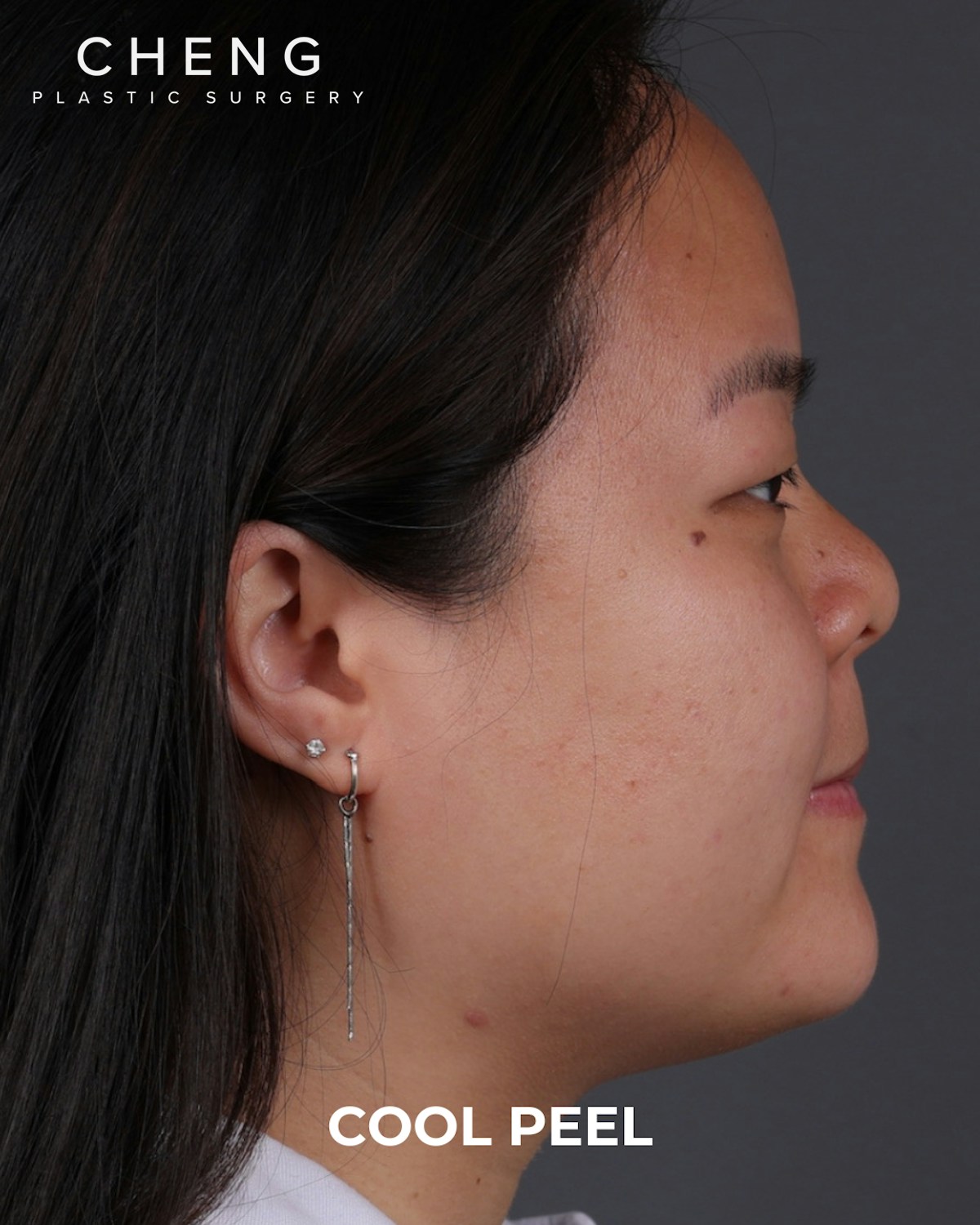 Co2 Laser Before & After Gallery - Patient 416341 - Image 3