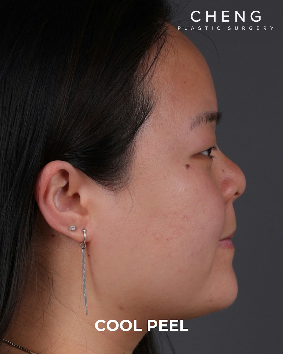 Co2 Laser Before & After Gallery - Patient 416341 - Image 4