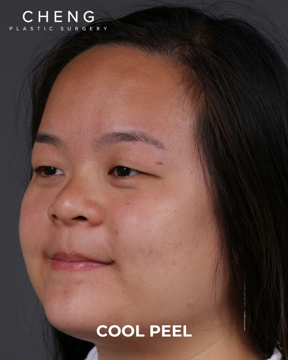 Co2 Laser Before & After Gallery - Patient 416341 - Image 7