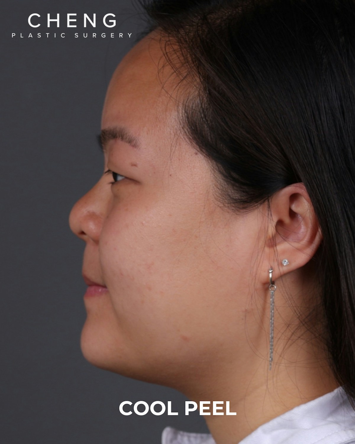 Co2 Laser Before & After Gallery - Patient 416341 - Image 9