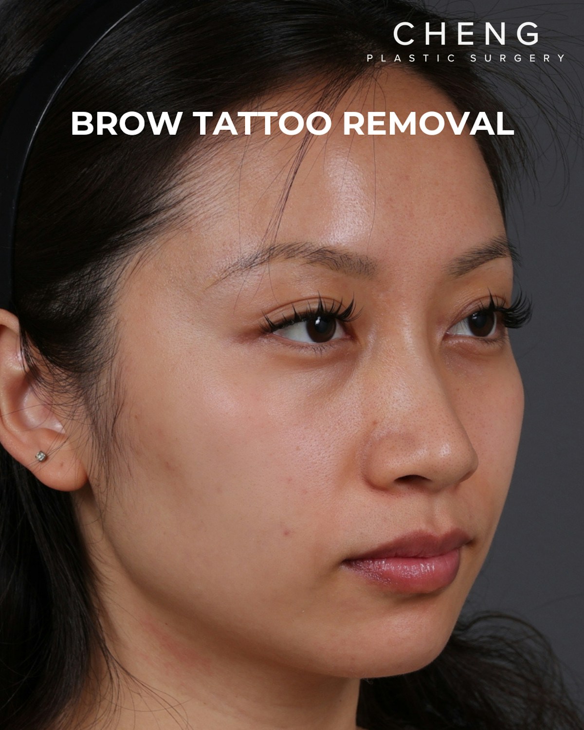 Brow Tattoo Removal Before & After Gallery - Patient 179499 - Image 4