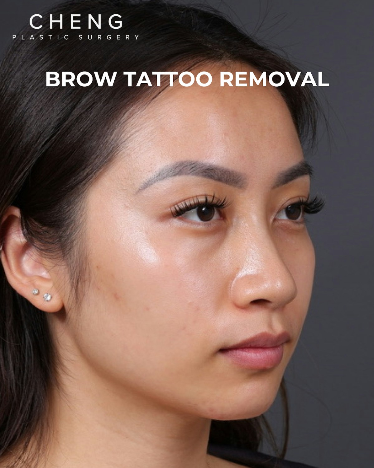 Brow Tattoo Removal Before & After Gallery - Patient 179499 - Image 3