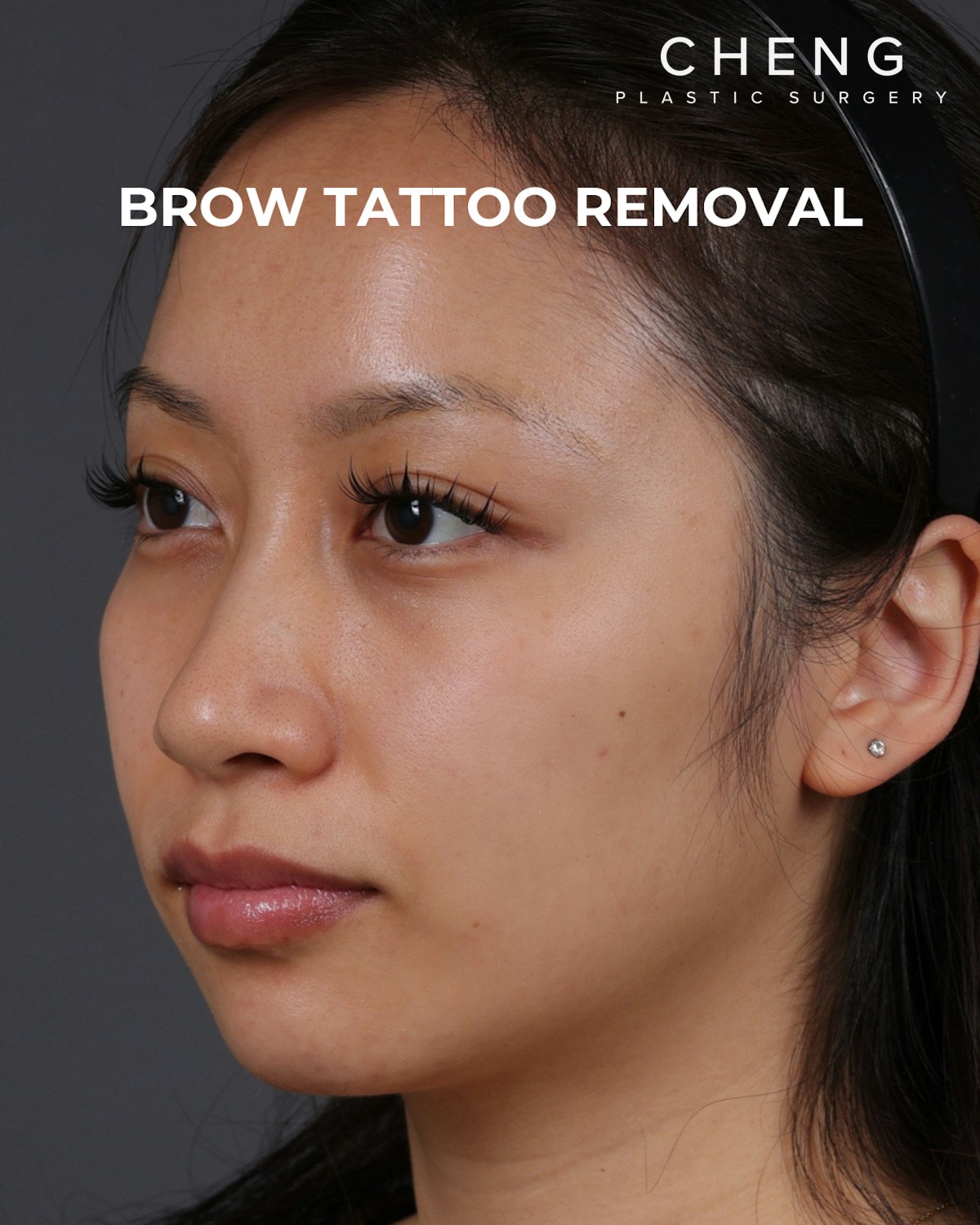 Brow Tattoo Removal Before & After Gallery - Patient 179499 - Image 6