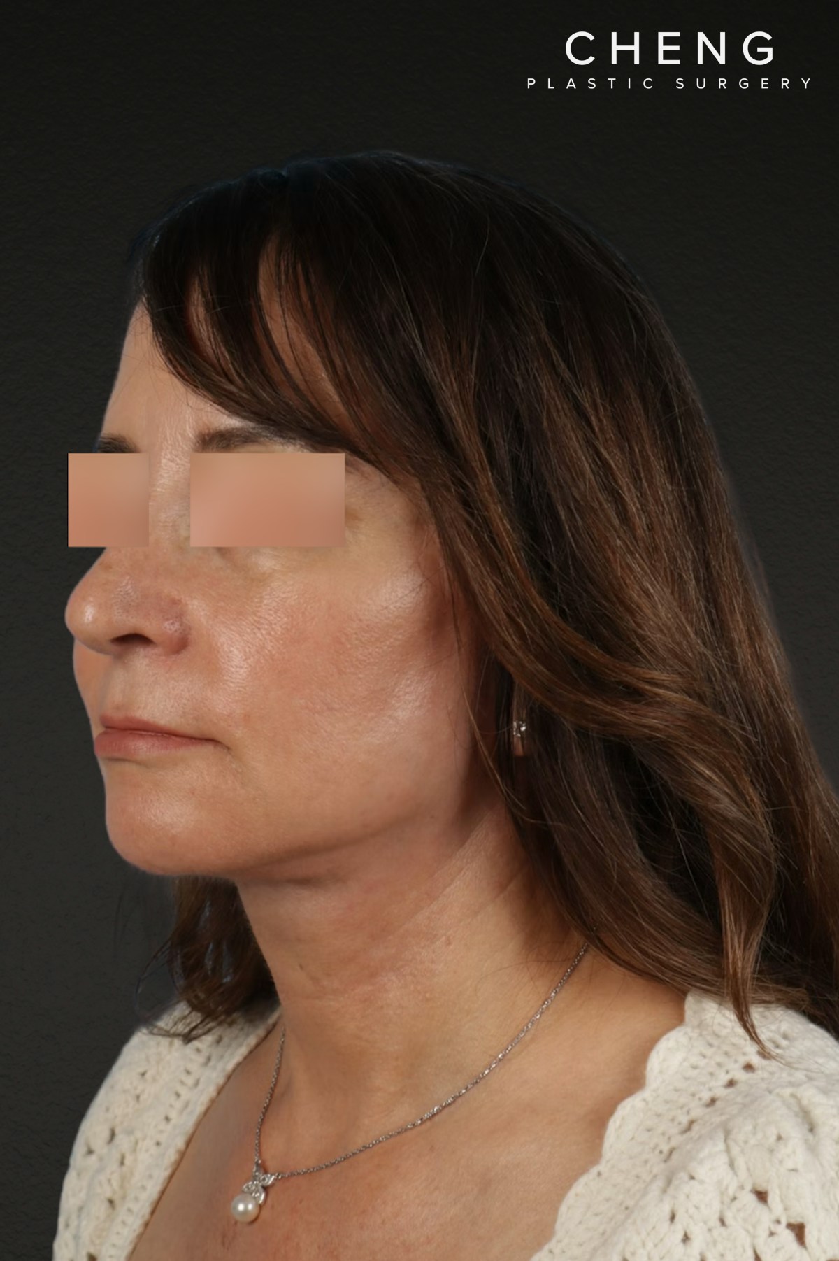 Neck Lift Before & After Gallery - Patient 428433 - Image 8