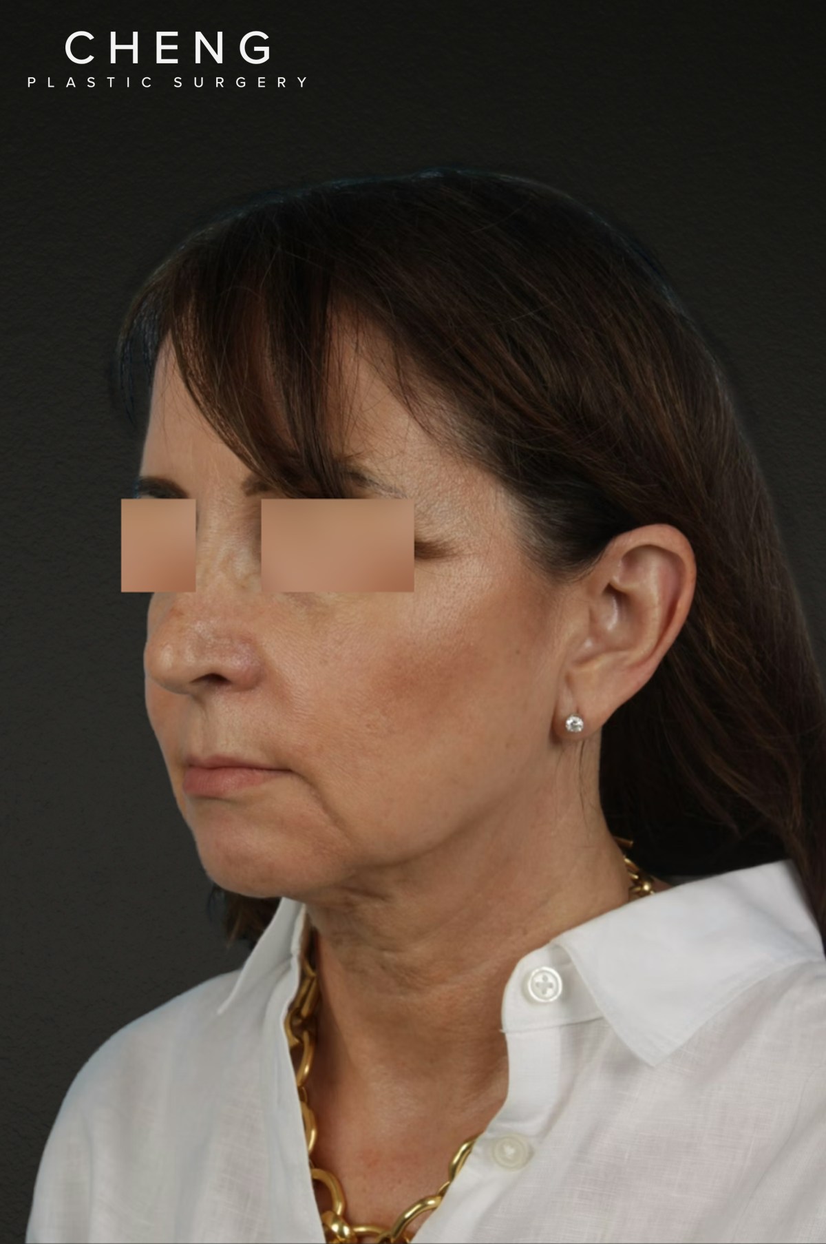 Neck Lift Before & After Gallery - Patient 428433 - Image 7
