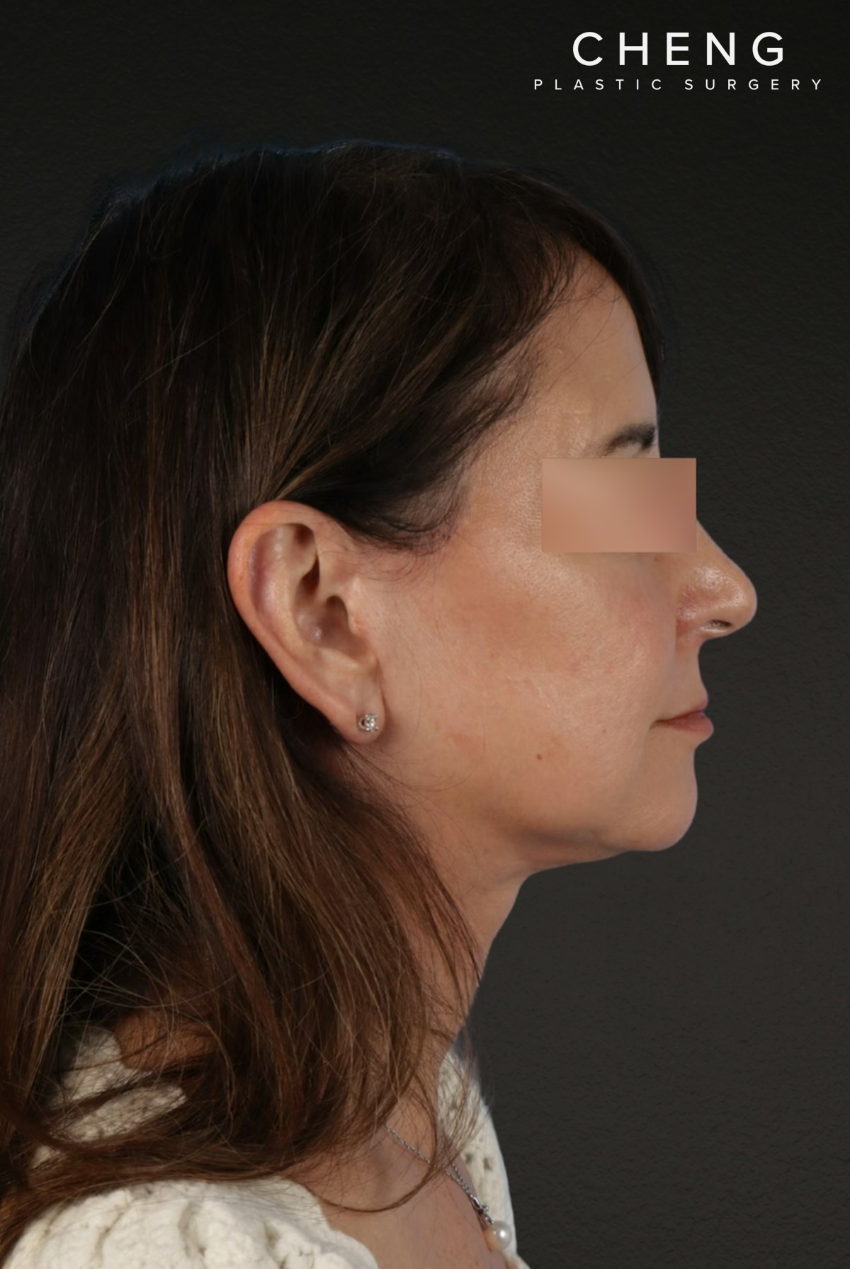 Neck Lift Before & After Gallery - Patient 428433 - Image 6