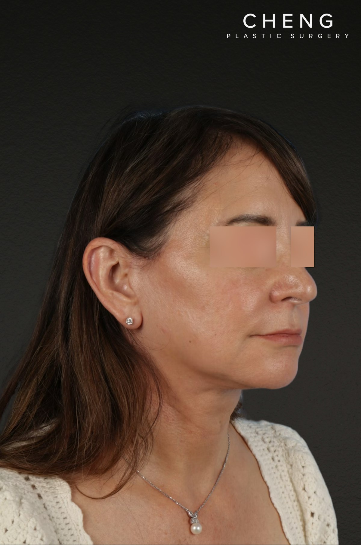 Neck Lift Before & After Gallery - Patient 428433 - Image 4