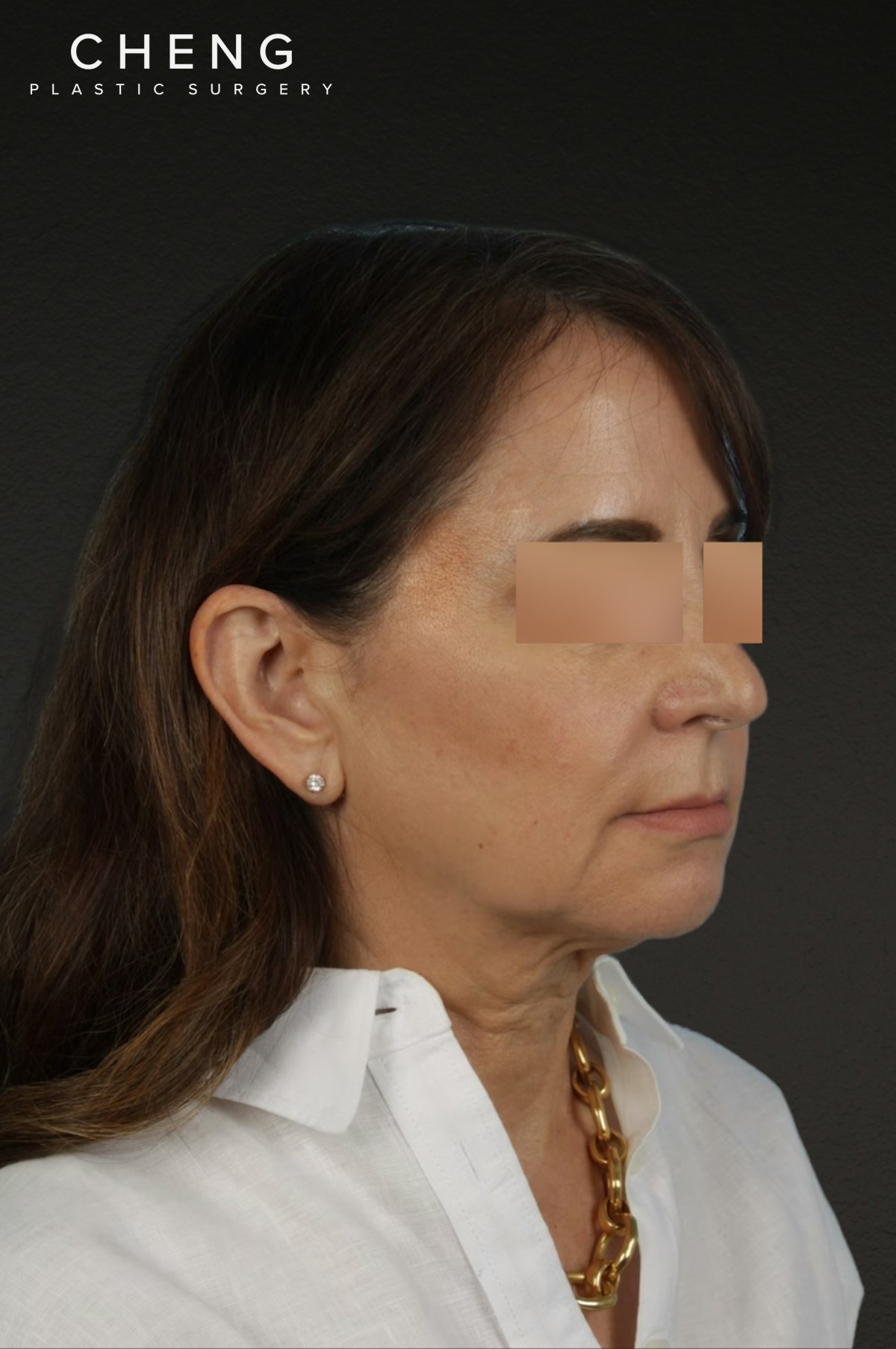 Neck Lift Before & After Gallery - Patient 428433 - Image 3