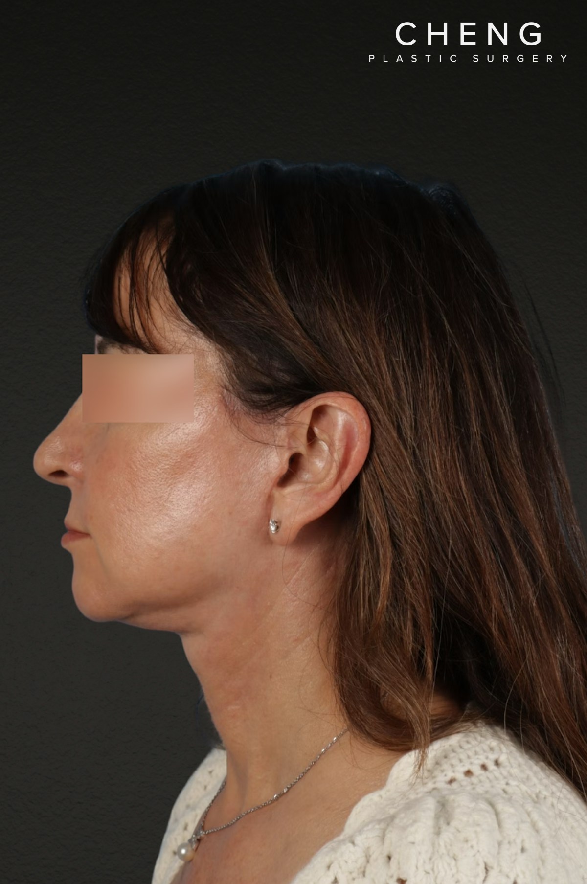 Neck Lift Before & After Gallery - Patient 428433 - Image 10