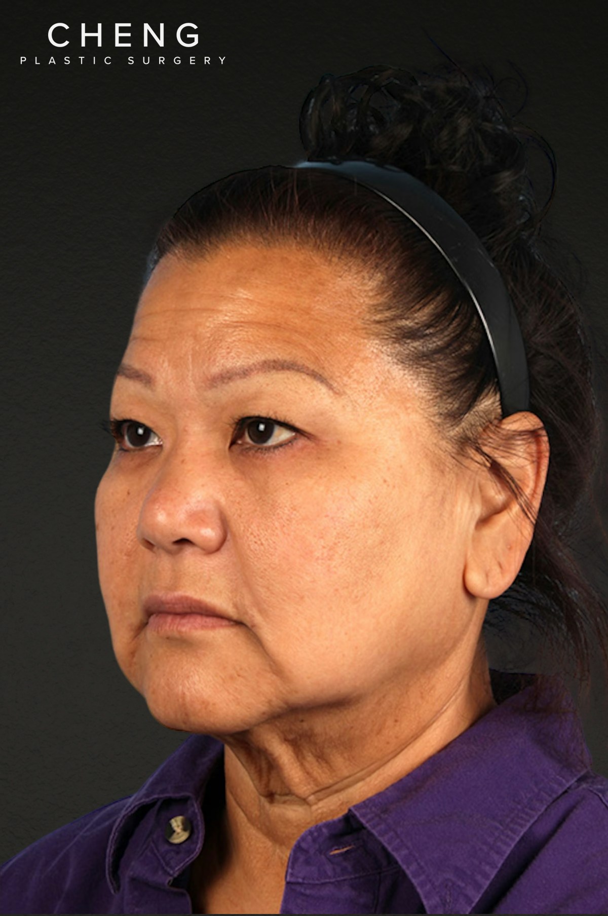Neck Lift Before & After Gallery - Patient 196183 - Image 1