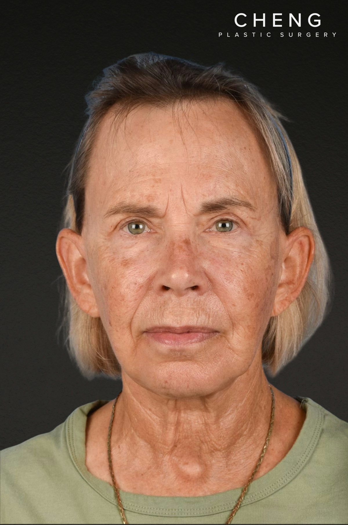 Neck Lift Before & After Gallery - Patient 310482 - Image 2