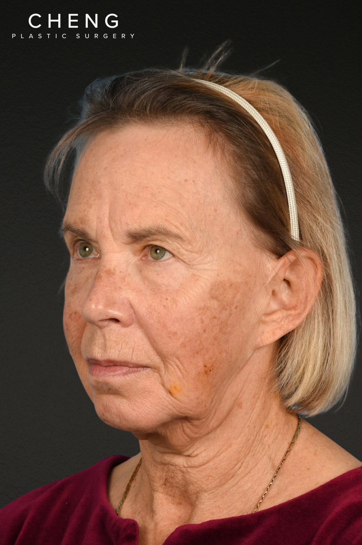 Neck Lift Before & After Gallery - Patient 310482 - Image 3
