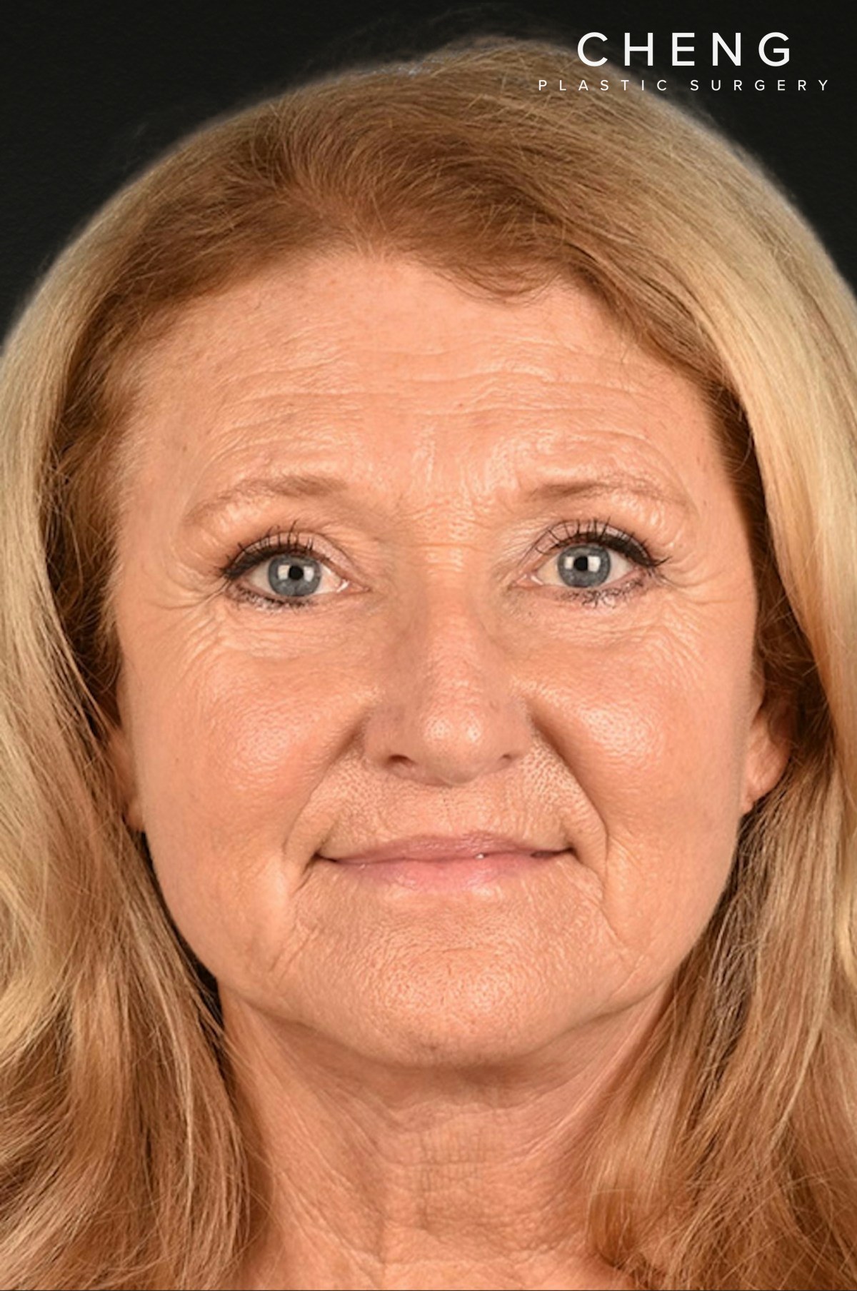 Neck Lift Before & After Gallery - Patient 302253 - Image 2