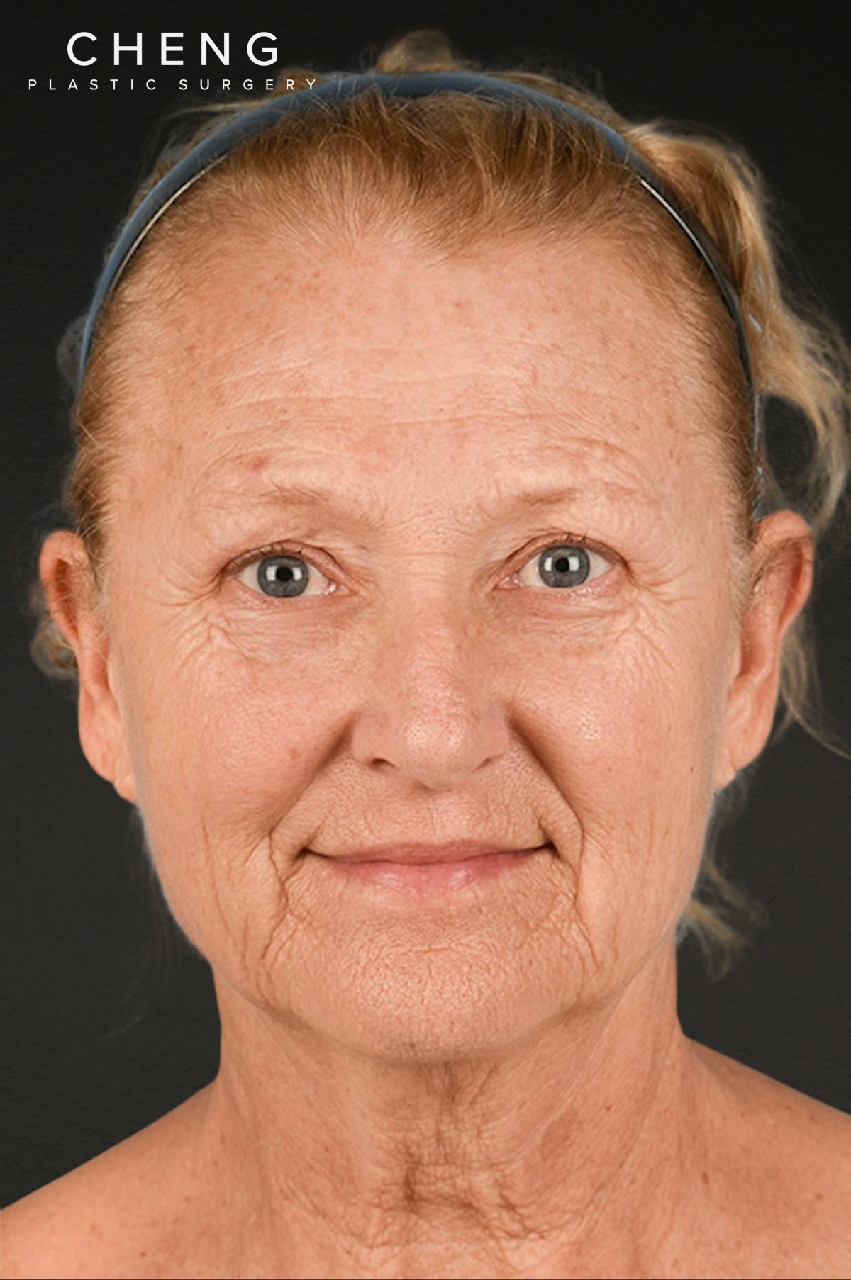 Neck Lift Before & After Gallery - Patient 302253 - Image 1