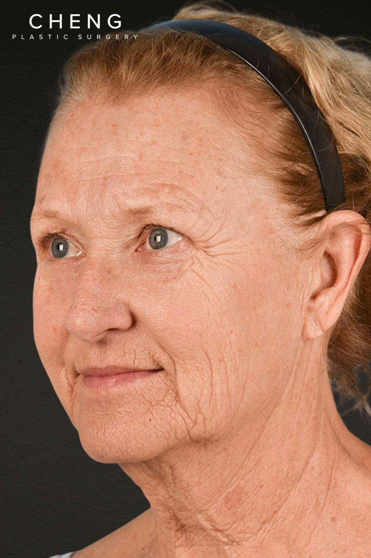 Neck Lift Before & After Gallery - Patient 302253 - Image 3