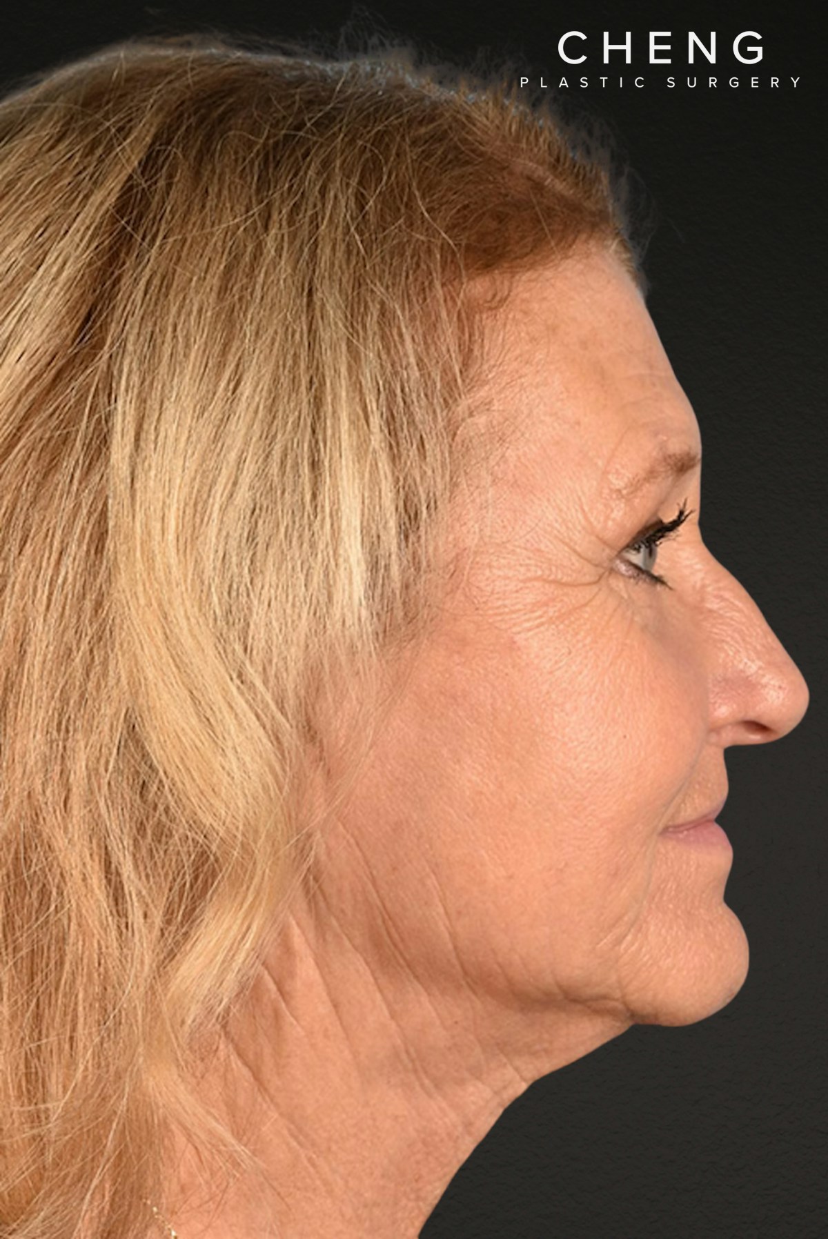 Neck Lift Before & After Gallery - Patient 302253 - Image 6