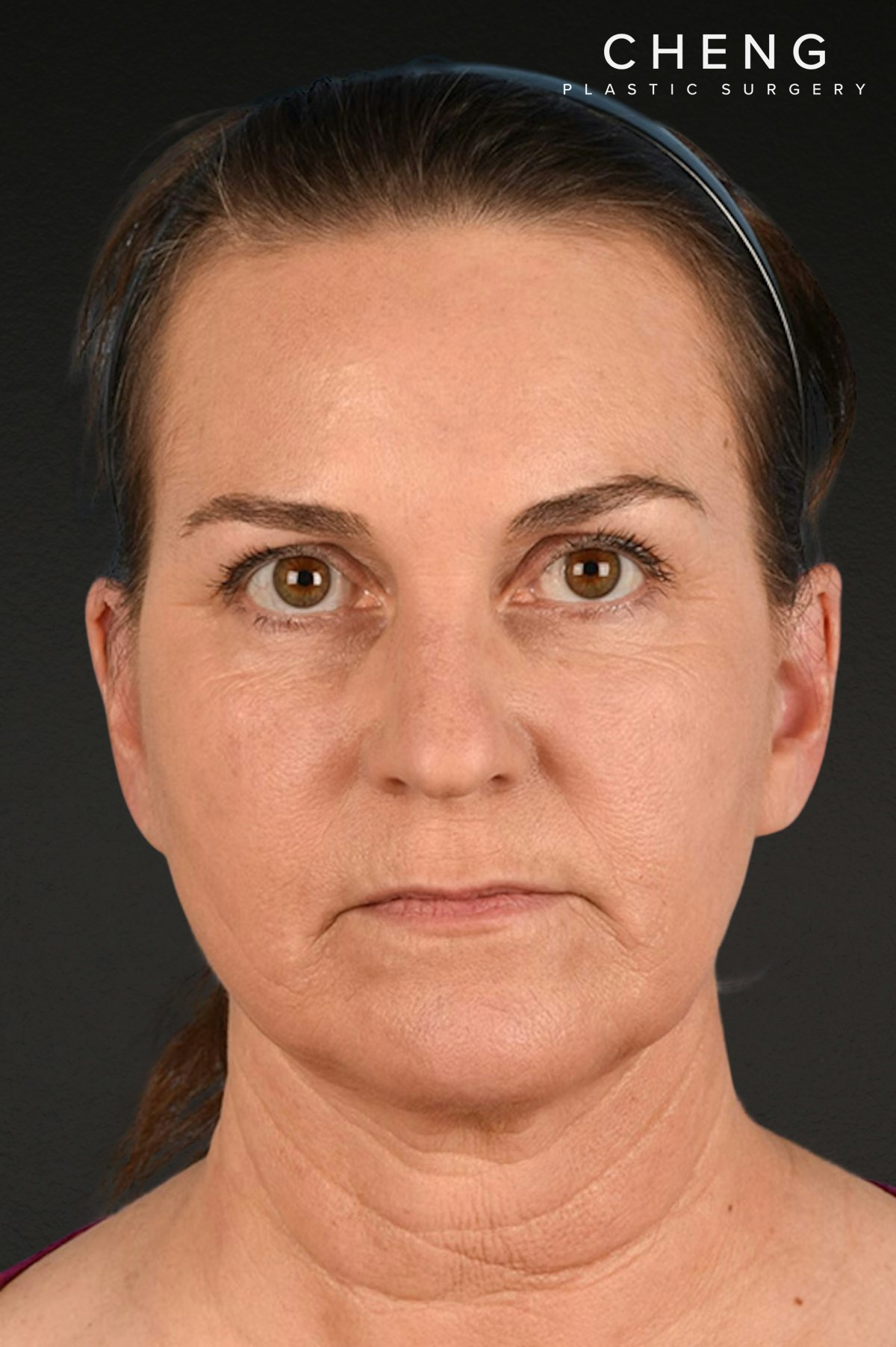 Neck Lift Before & After Gallery - Patient 169561 - Image 2