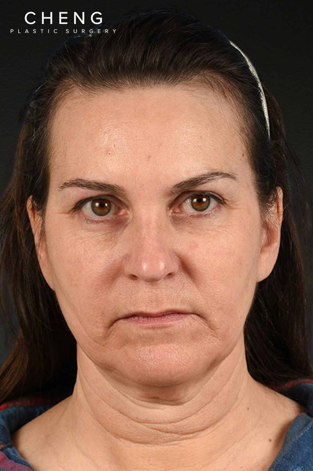 Neck Lift Before & After Gallery - Patient 169561 - Image 1