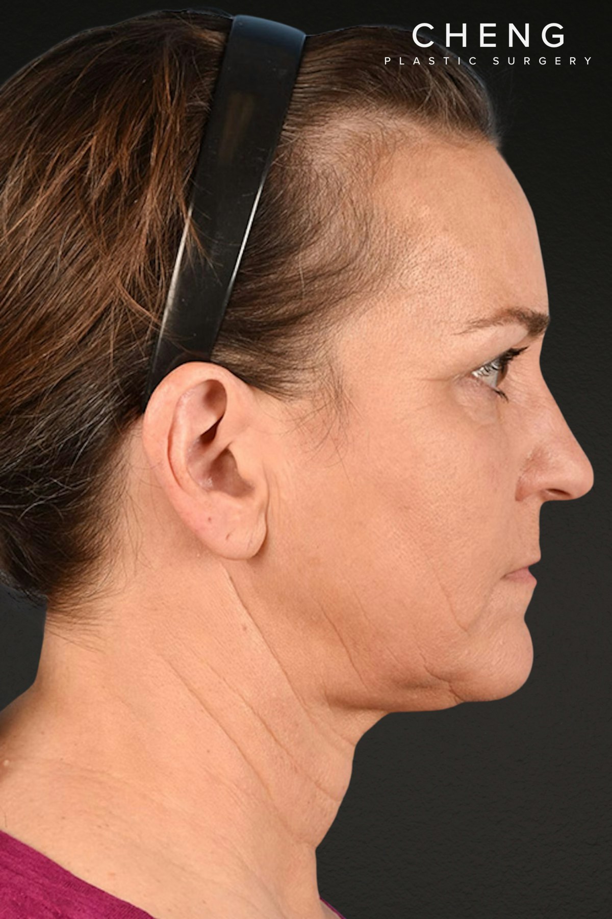 Neck Lift Before & After Gallery - Patient 169561 - Image 6