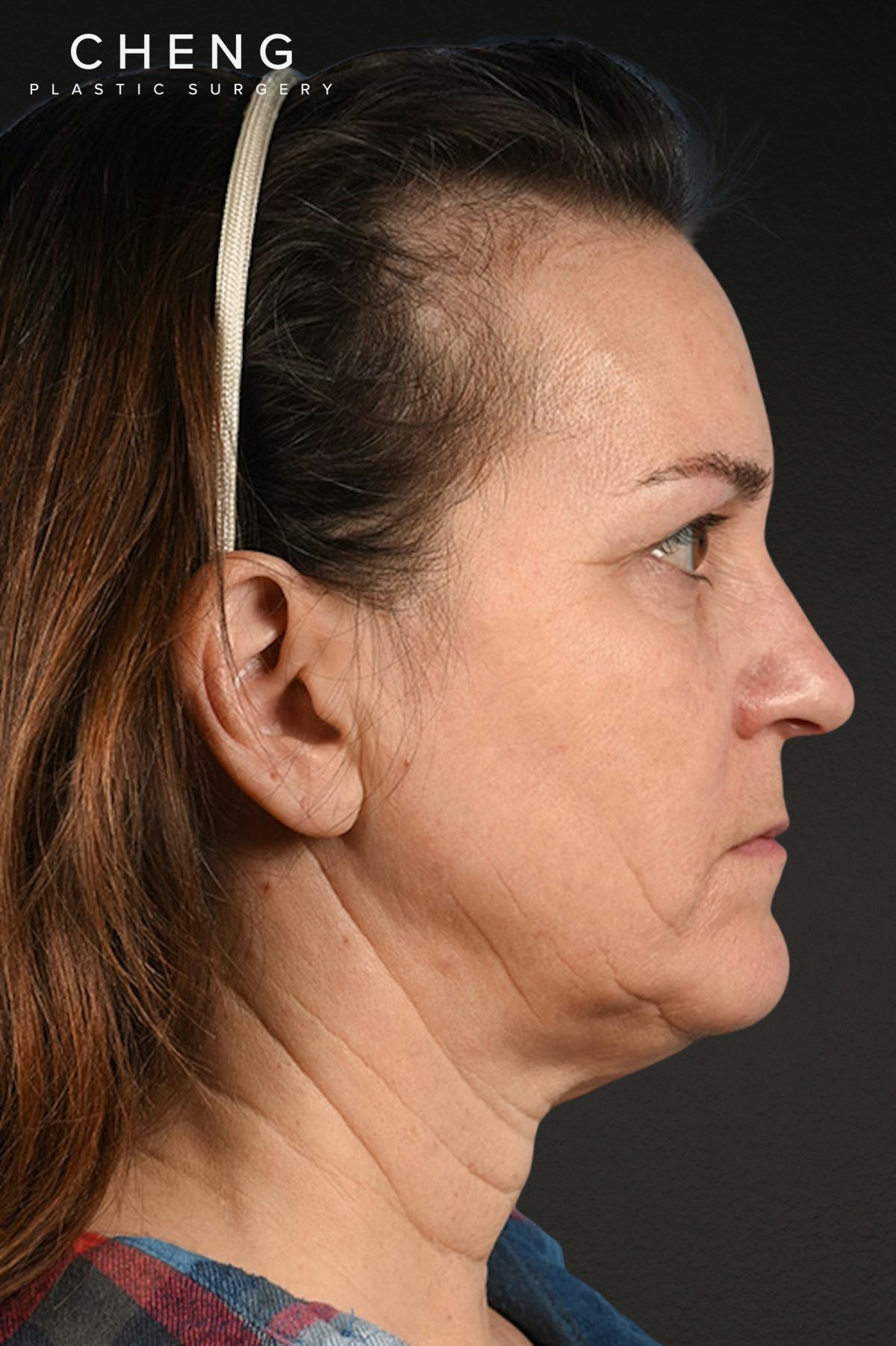 Neck Lift Before & After Gallery - Patient 169561 - Image 5