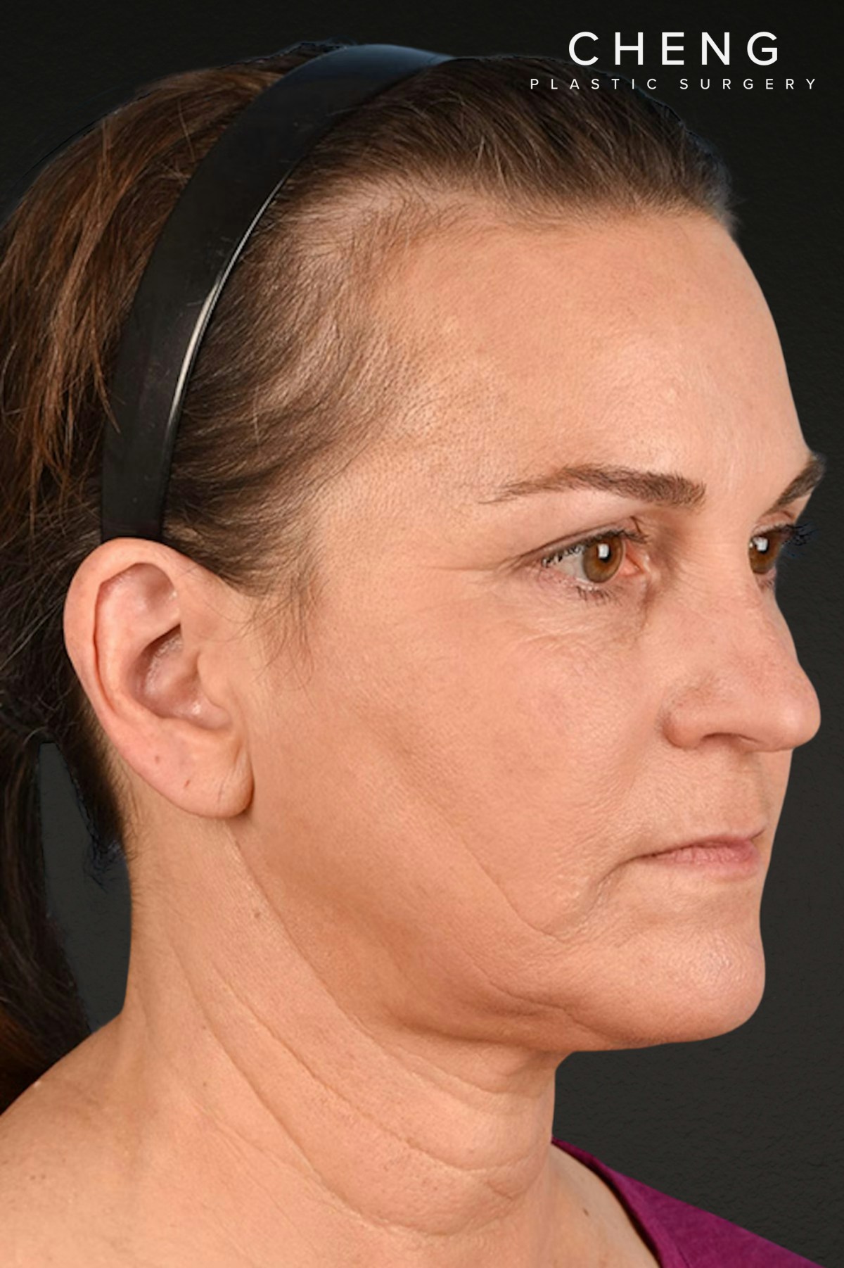 Neck Lift Before & After Gallery - Patient 169561 - Image 4