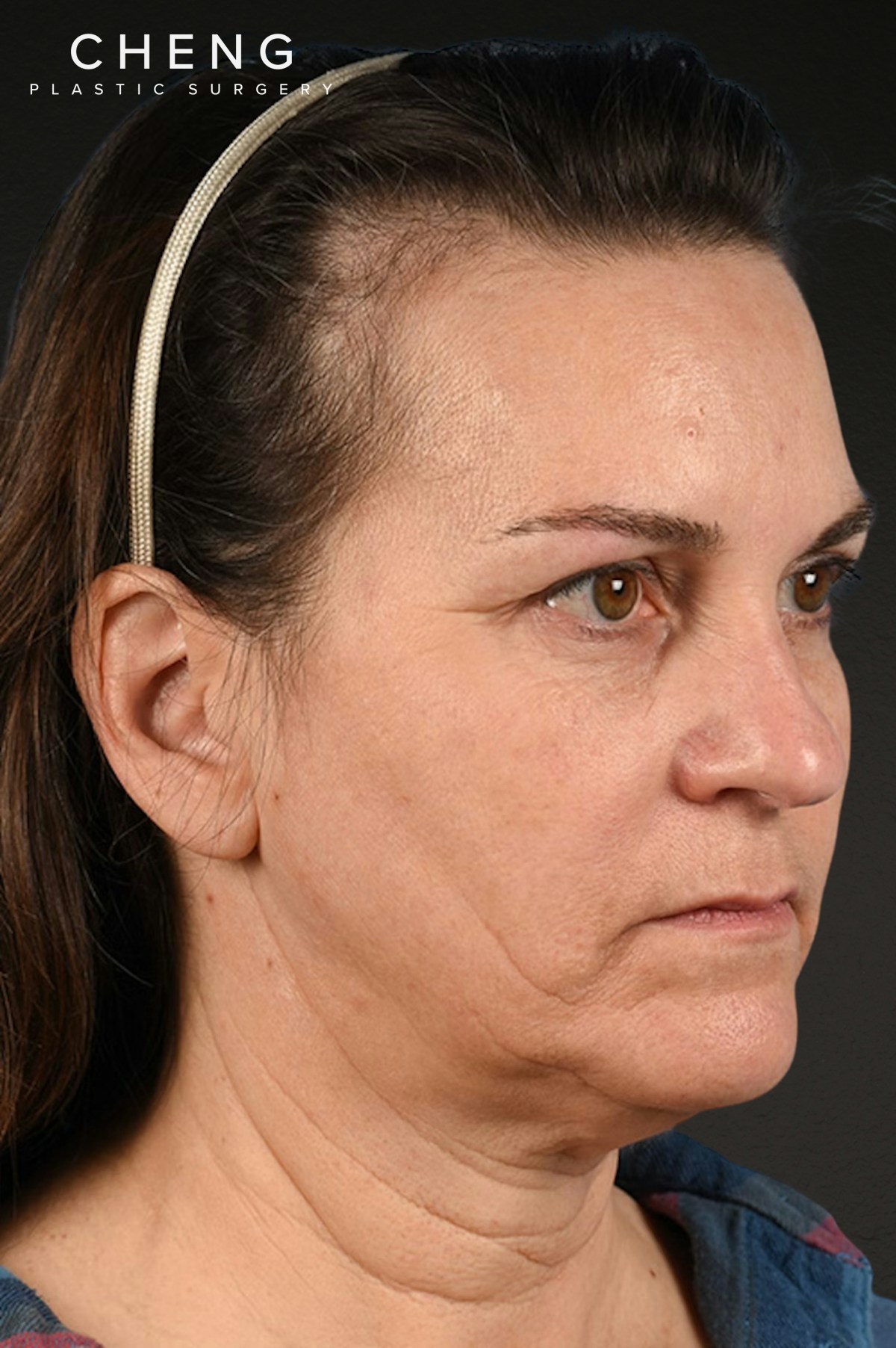 Neck Lift Before & After Gallery - Patient 169561 - Image 3