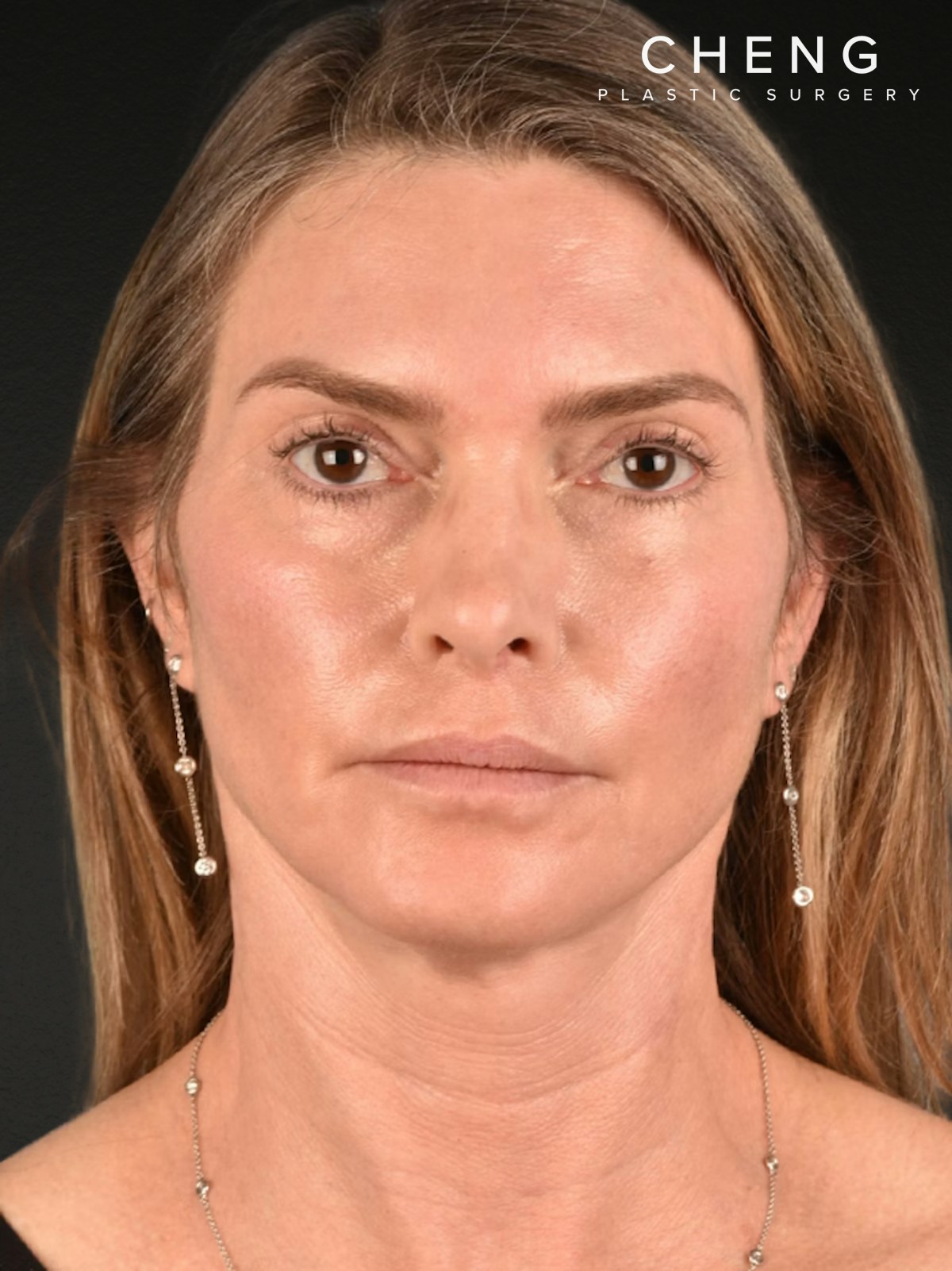 Neck Lift Before & After Gallery - Patient 223130 - Image 2