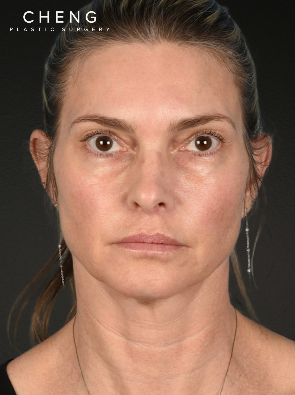 Neck Lift Before & After Gallery - Patient 223130 - Image 1