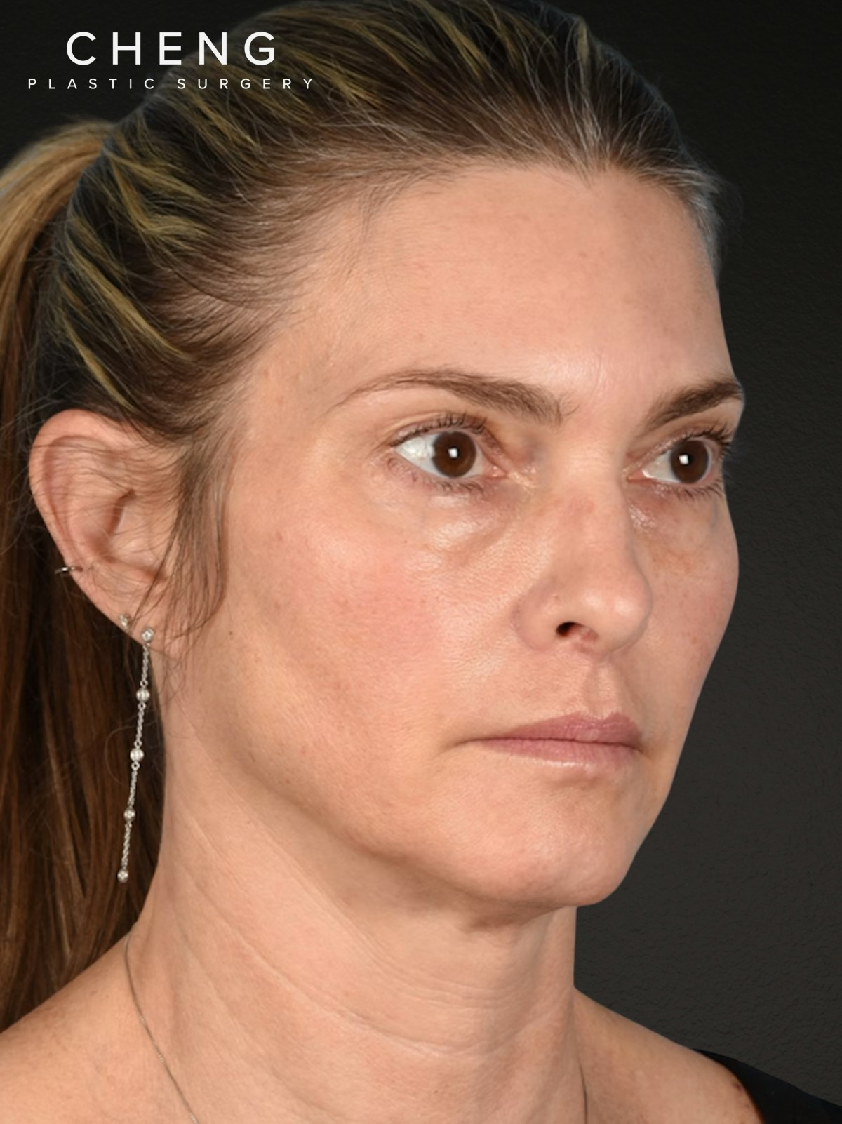 Neck Lift Before & After Gallery - Patient 223130 - Image 3