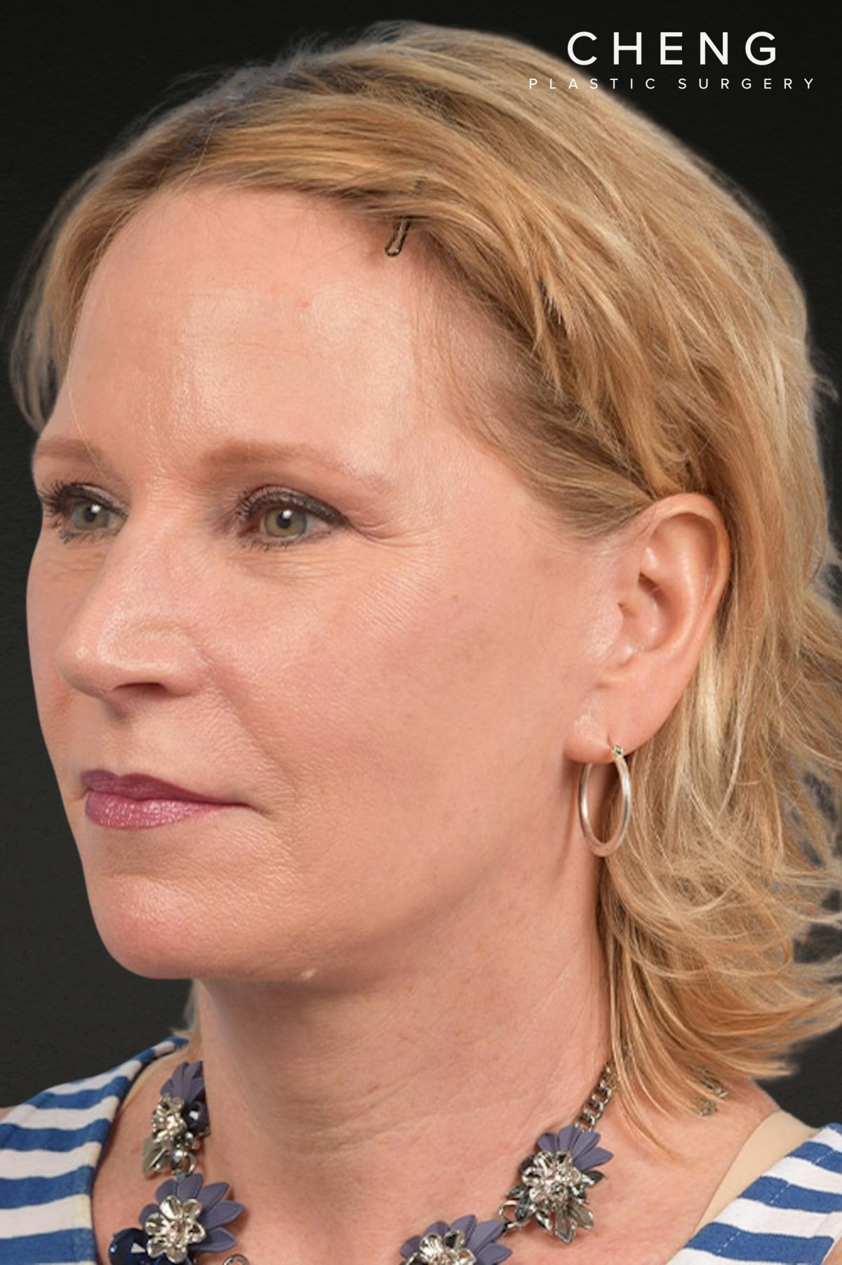 Neck Lift Before & After Gallery - Patient 250758 - Image 4