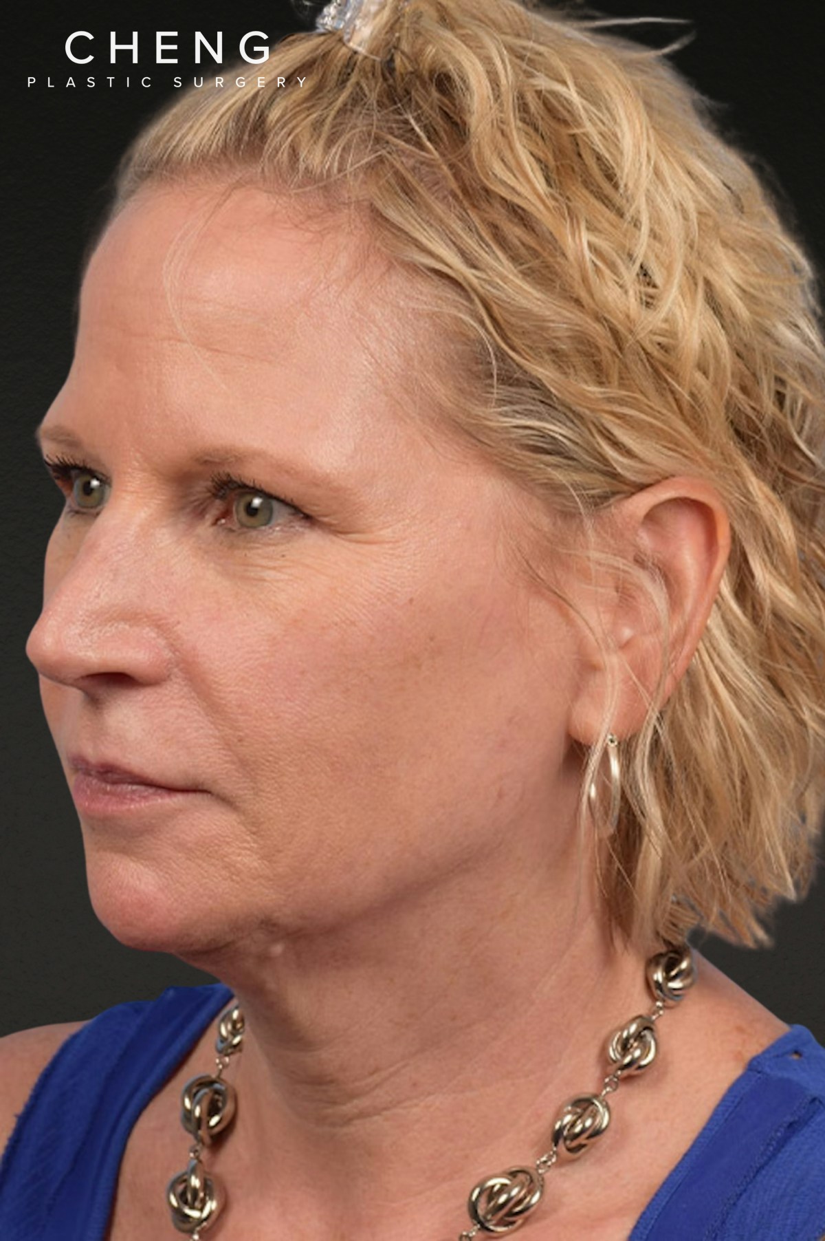 Neck Lift Before & After Gallery - Patient 250758 - Image 3