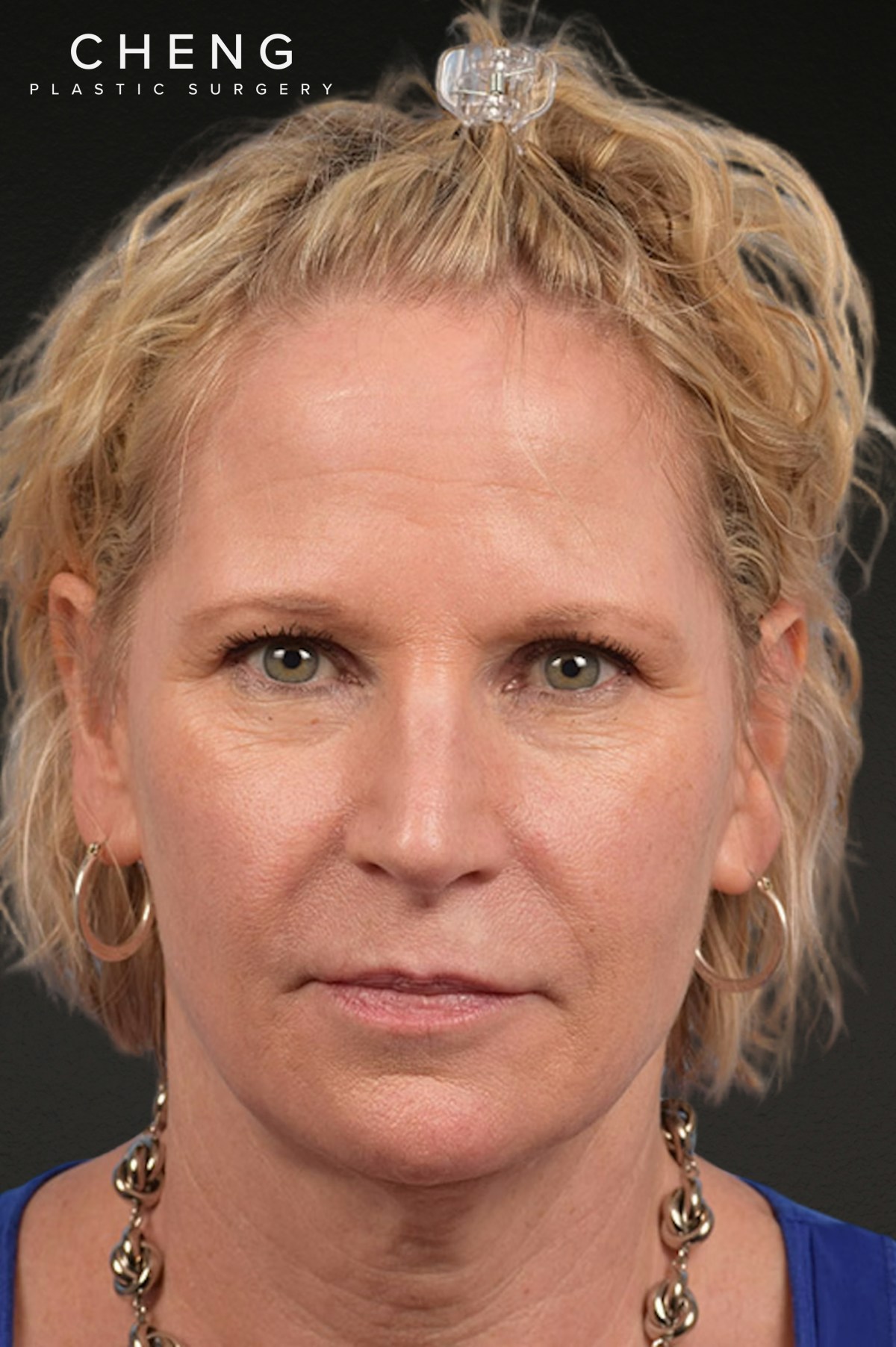 Neck Lift Before & After Gallery - Patient 250758 - Image 1