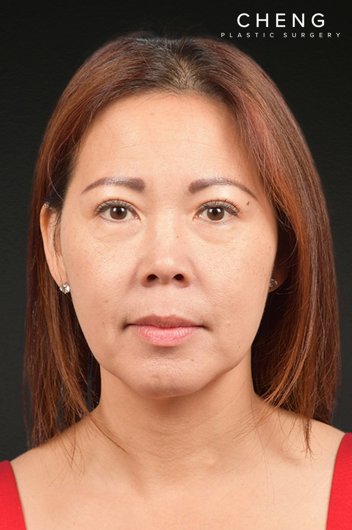 Neck Lift Before & After Gallery - Patient 289705 - Image 2