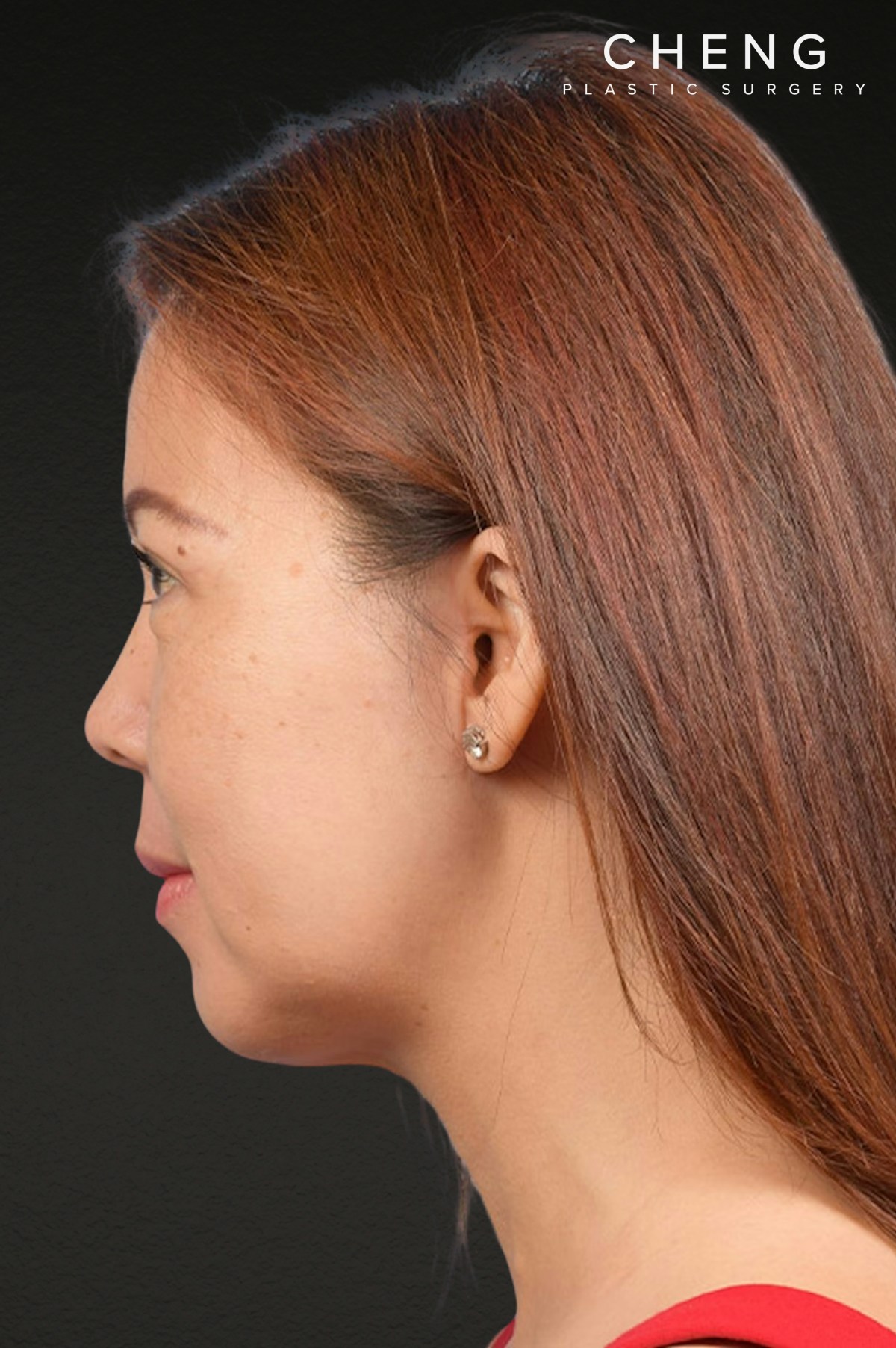 Neck Lift Before & After Gallery - Patient 289705 - Image 10