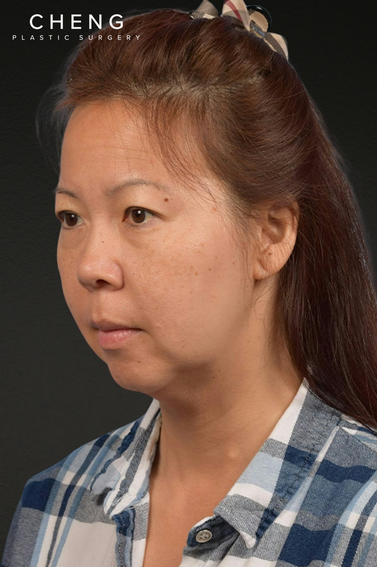 Neck Lift Before & After Gallery - Patient 289705 - Image 7