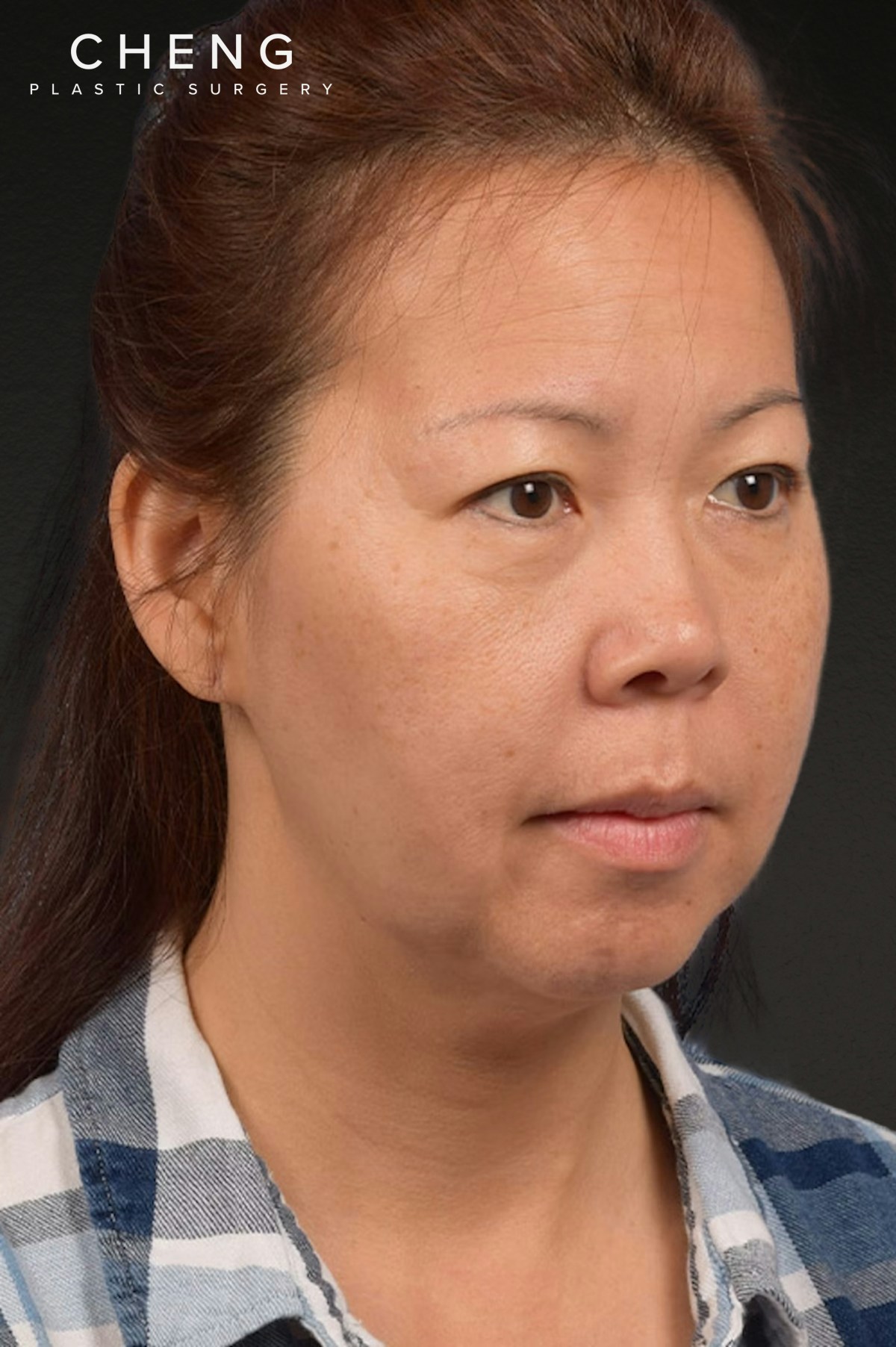 Neck Lift Before & After Gallery - Patient 289705 - Image 3