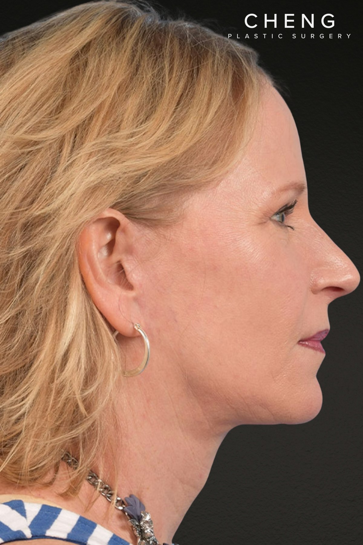 Neck Lift Before & After Gallery - Patient 250758 - Image 10
