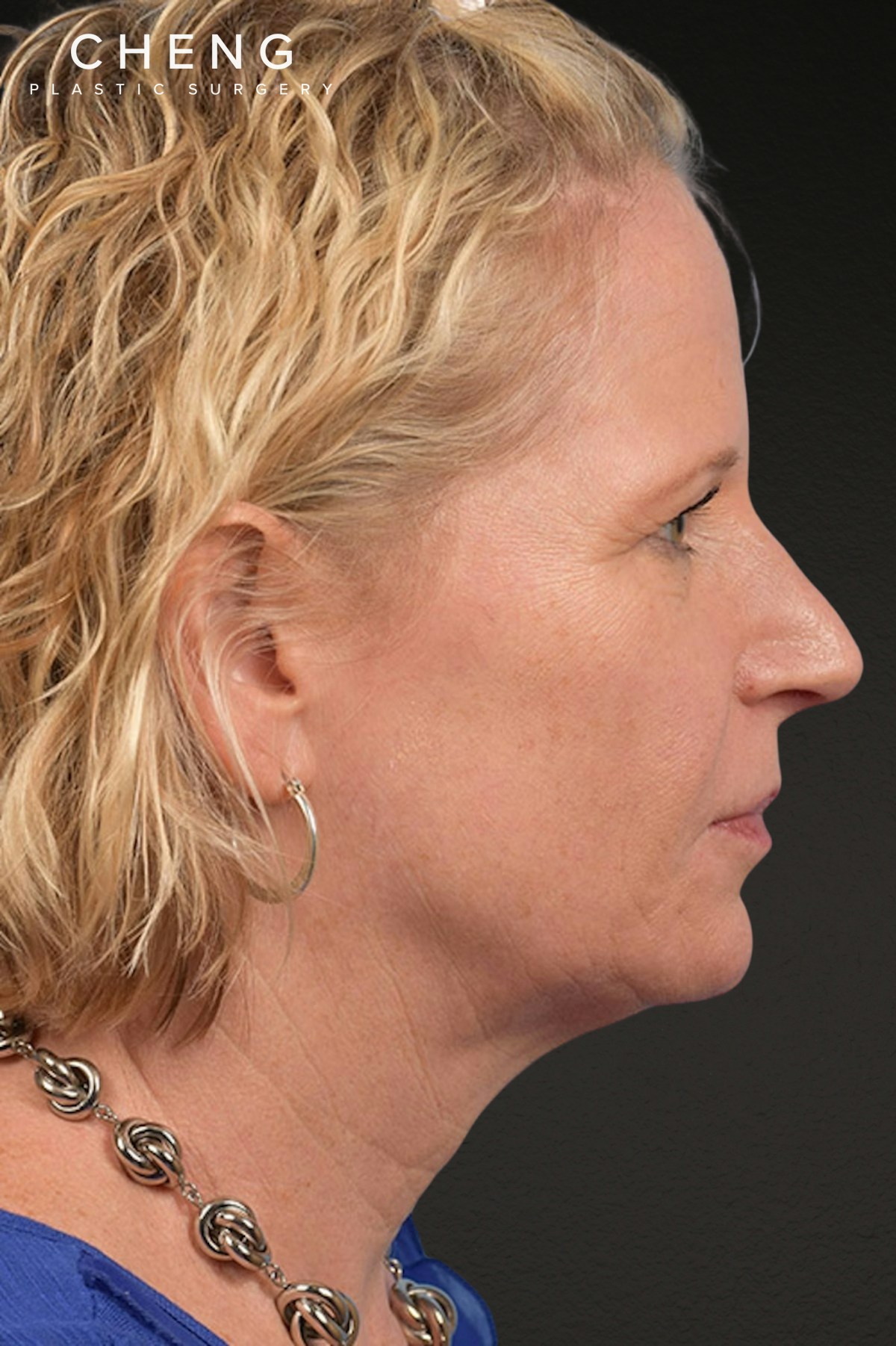 Neck Lift Before & After Gallery - Patient 250758 - Image 9