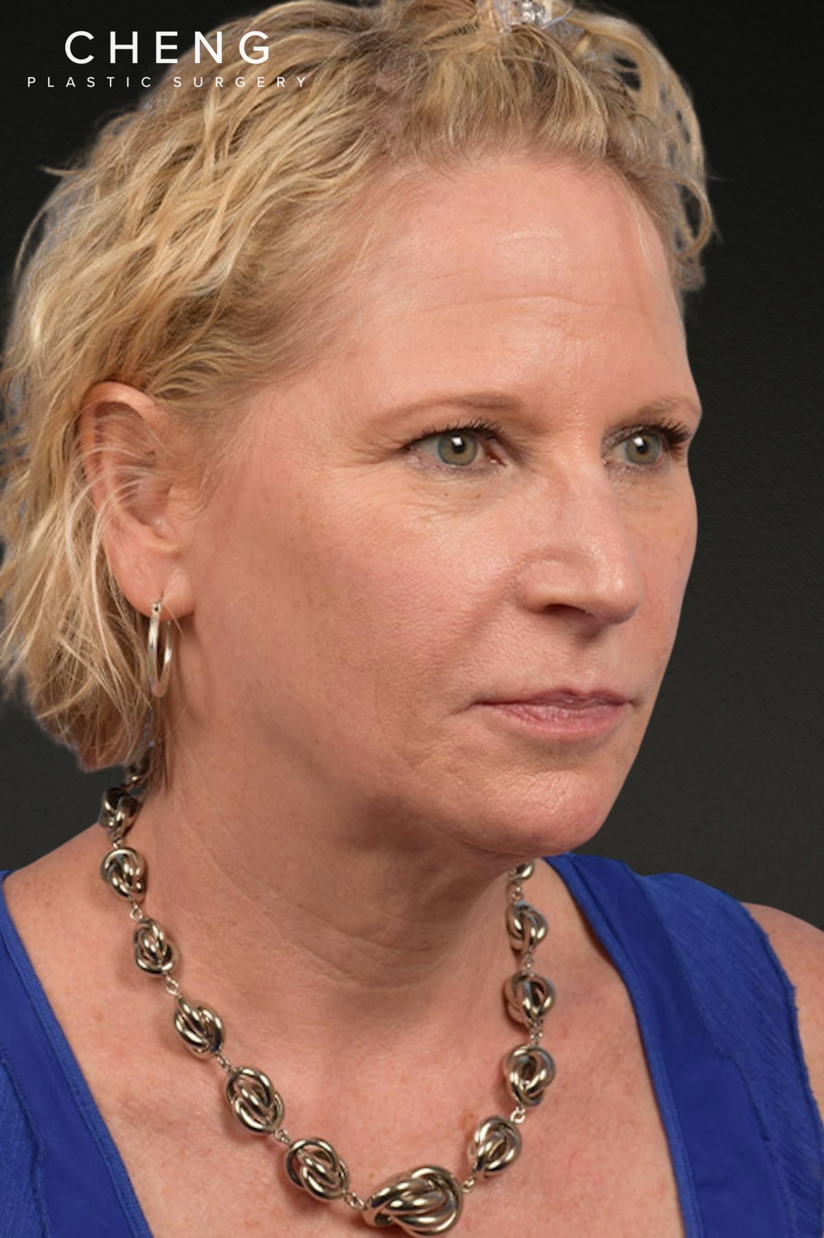 Neck Lift Before & After Gallery - Patient 250758 - Image 7