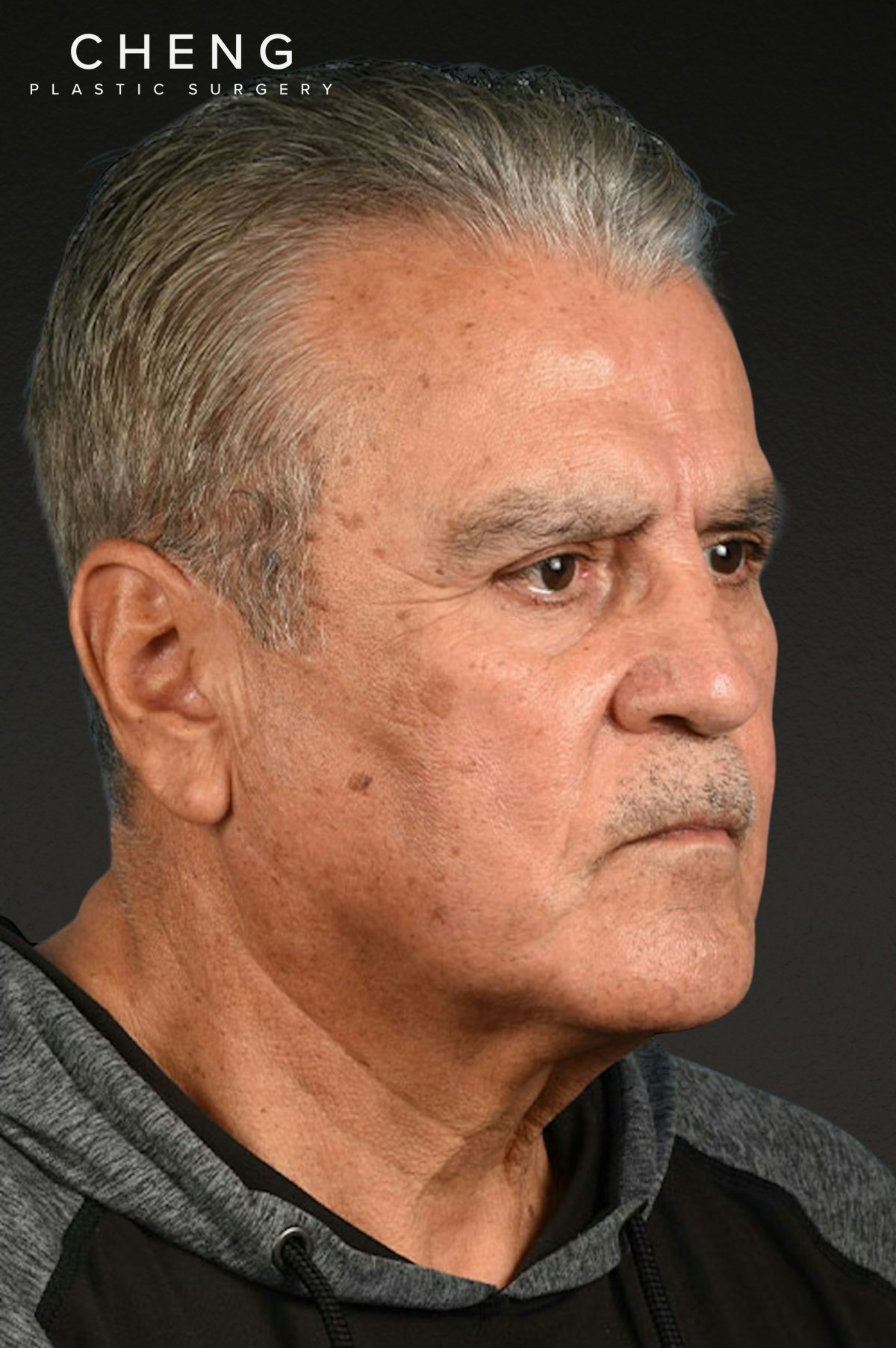 Neck Lift Before & After Gallery - Patient 151912 - Image 1