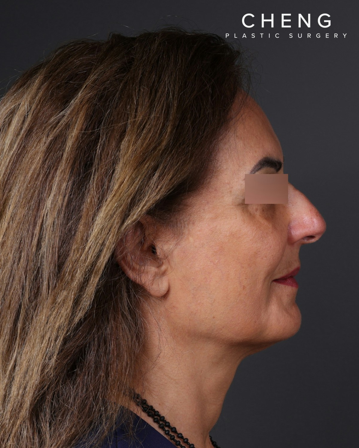 Thread Lifting Before & After Gallery - Patient 573741 - Image 6